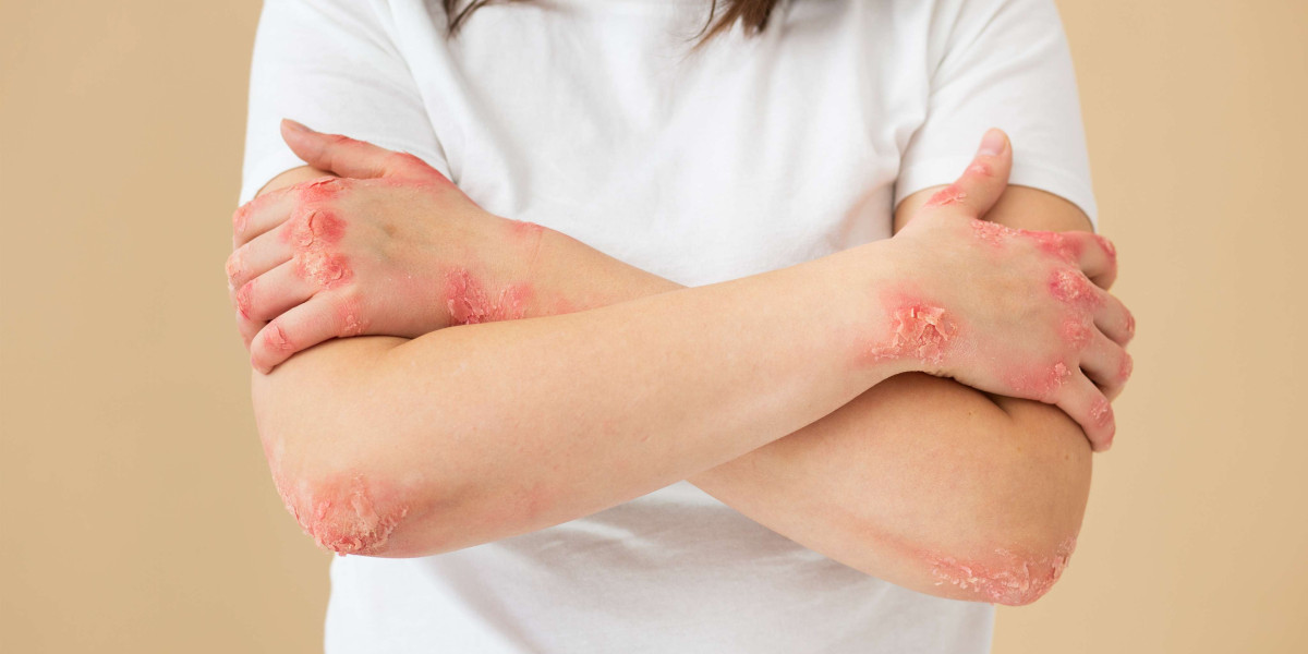 Ivercor 12 mg Manufacturers with Proven Results for Scabies, Filariasis