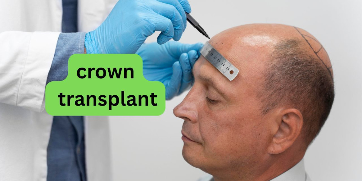 Restore Hair Confidence with a Crown Transplant